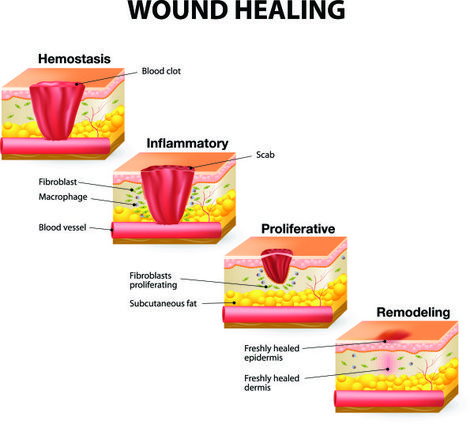 How Wounds Heal: The 4 Main Phases of Wound Healing | Shield HealthCare Wound Healing Nursing, Healing Illustration, Stages Of Healing, Wound Care Nursing, Healing Images, Integumentary System, Collagen Fibers, Skin Moles, Fundamentals Of Nursing