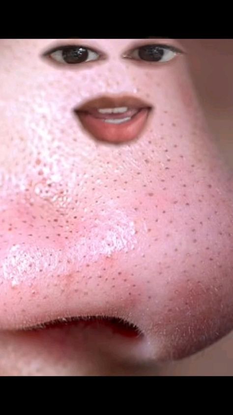 Blackheads & Sebaceous Filament Small Bumps On Forehead, Oily Nose, Small Bumps On Face, Nose Pimples, Forehead Bumps, Pimples On Forehead, Sebaceous Filaments, Small Pimples, Blind Pimple