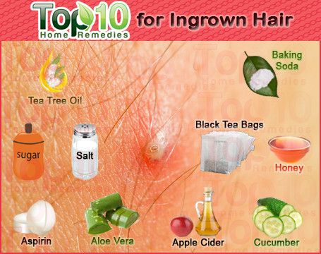 Home Remedies for Ingrown Hair Brazilian Wax, Hair Home Remedies, Infected Ingrown Hair, Ingrown Hair Remedies, Top 10 Home Remedies, Underarm Hair Removal, Razor Bumps, Home Remedies For Hair, Diy Remedies