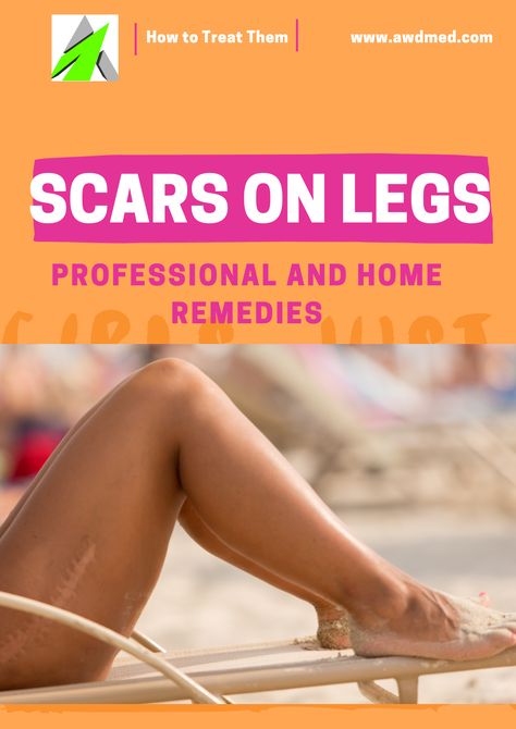 Don’t let dark spots, bite marks, or old scars stop you from wearing your favorite short outfits. Read this piece to learn how to get rid of scars on legs. #howtogetridofatrophicscrasonyourlegs #howtoremovescarsonlegsfromchildhood #Howtotreatburnscarsonyourlegs #howtogetridofscrasonlegsfromshaving How To Remove Marks From Legs, Dark Scar Removal On Legs, Skin Discoloration On Legs Signs, Dark Spots On Legs How To Get Rid Of, Dark Spots On Legs Remove Diy, Dark Marks On Legs How To Get Rid Of, Dark Spots On Body How To Remove, Scar Removal Remedies Leg, Remove Dark Spots On Legs Fast