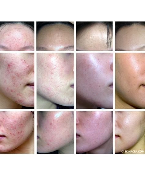 Severe Acne Remedies, Clear Skin Detox, Clear Skin Overnight, Hormonal Acne Remedies, Cystic Acne Remedies, Different Types Of Acne, Overnight Acne Remedies, Acne Products, Treat Acne