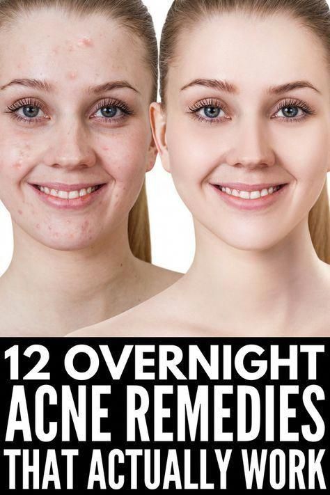 Want to know how to get rid of acne overnight? Check out this collection of 12 simple yet effective natural remedies that work! Rid Of Acne Overnight, Get Rid Of Acne Overnight, What Causes Warts, Black Spots On Face, Sunspots On Face, Spots On Forehead, Overnight Acne Remedies, Get Rid Of Pimples, Brown Age Spots