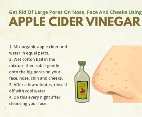 Large Pores On Nose, Open Pores On Face, Nose Pimples, Cheek Acne, Nose Pores, Blackheads On Nose, Open Pores, Large Pores, Beauty Remedies