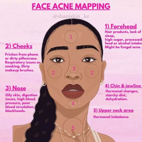 Why You Get Acne In Certain Areas, Acne On Face Meaning, How To Reduce Forehead Acne, Acne Places Meaning, Acne Mapping Face, Acne Spots Meaning, Things That Help With Acne, How To Reduce Forehead Size, How To Stop Picking Your Face