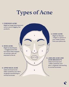 Figuring out what causes acne can be tough, but helping to prevent breakouts just takes a little detective work. Acne face mapping can be key to helping identify the acne cause. While many factors can lead to acne breakouts, the location on your face can be a revealing clue. Click now to find out the meaning behind pimples on your chin, cheeks, jawline and neck. Face Breakout Chart, Meaning Of Pimples On Face, Acne Above Lip Meaning, Pimple Meaning Face Mapping, Pimples On Nose Meaning, Pimple On Nose Meaning, Acne Location Meaning Face Mapping, What Causes Forehead Acne, Acne Chin And Jaw