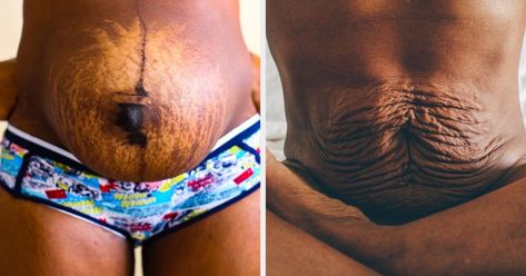 Postpartum Black Women, Postpartum Photo Shoot, Real Postpartum Bodies, Before And After Postpartum, Real Mom Bodies, Triplet Pregnancy Belly, Pregnancy Before And After Photos, Twin Belly Bump, Postpartum Body Transformation