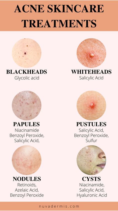 The Ultimate Guide to Acne (With Pictures) & How to Treat At Home Pimple Cream, Skin Care Basics, Dry Skincare, Skin Care Business, Clear Healthy Skin, Dry Skin On Face, Sephora Skin Care, Natural Face Skin Care, Face Care Routine