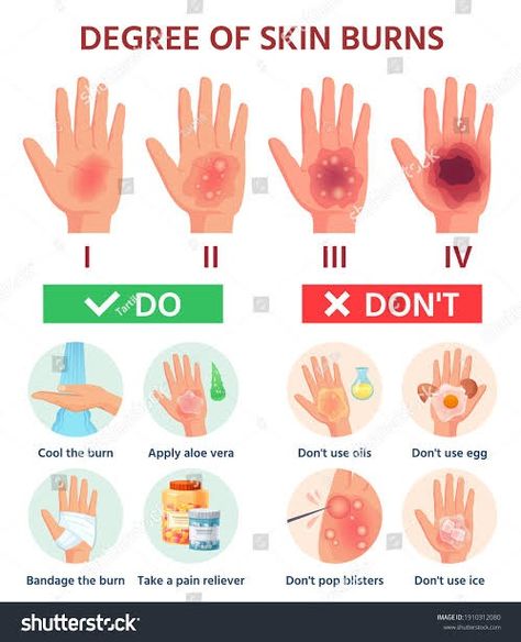 Burn Wound, First Aid Poster, First Aid For Burns, Burn Injury, First Aid Tips, Basic First Aid, Degree Burns, Safety And First Aid, Skin Burns