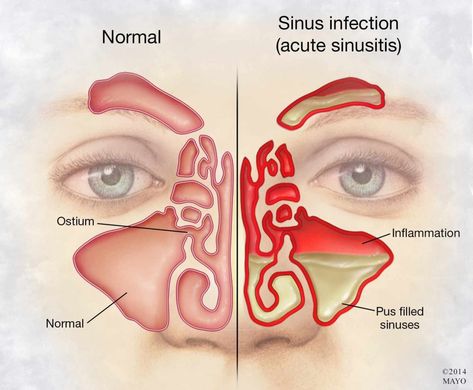 Treating Sinus Infections Without Antibiotics – Mayo Clinic News Network Treating Sinus Infection, Remedy For Sinus Congestion, Relieve Sinus Congestion, Acute Sinusitis, Home Remedies For Sinus, Sinus Remedies, Sinus Congestion Relief, Maxillary Sinus, Sinus Infection Remedies