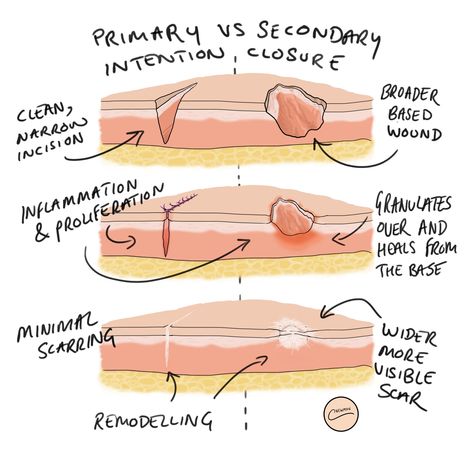 Wound Healing Nursing, Mortuary School, Suture Types, Nursing Facts, Wound Care Nursing, Myofunctional Therapy, Np School, Skin Anatomy, Nursing School Essential