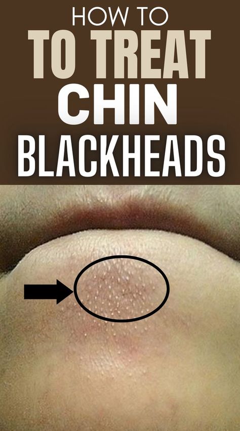 How to Quickly and Easily Remove Blackheads from Your Chin at Home Get Rid Of Pores, Blackheads On Nose, Face Pores, Remove Blackheads, Cold Sores Remedies, Get Rid Of Blackheads, Skin Pores, Remove Acne, Unwanted Hair Removal