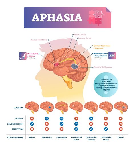 Types Of Speech, Speech Language Pathology Grad School, Infographic Diagram, Anatomical Brain, Brain Neurons, Brain Vector, Illustration Infographic, Skull Anatomy, Language Disorders