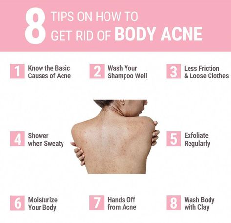 Body acne stress us out whenever summer is around the corner. But worry no more with these 8 easy tips to help prevent & remove acne on your back and chest! How To Clear Back Acne Fast, How To Remove Back Acne, Back Acne Scar Removal, How To Treat Back Acne, How To Get Rid Of Chest Acne, How To Get Rid Of Back Acne, Body Acne How To Get Rid Of, How To Clear Back Acne, Acne On Back