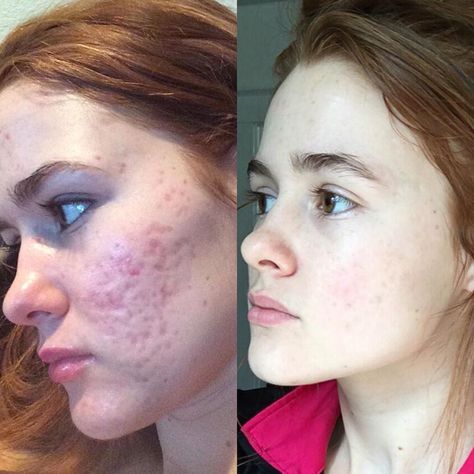 Acne Scar Cream, Acne Scar Diy, Cosmetic Fillers, Acne Scar Mask, Scar Cream, Before And After Pics, Get Rid Of Acne, Acne Scar, Rid Of Acne