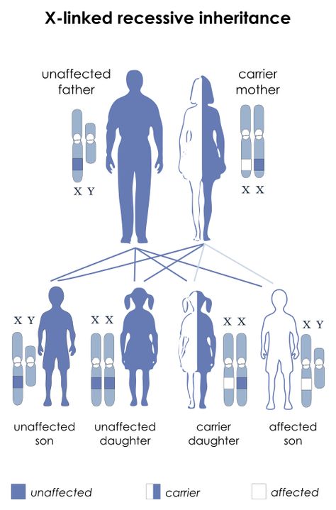 X-Linked Recessive Inheritance. X-linked recessive inheritance is a mode of inheritance in which a mutation in a gene on the X chromosome causes the phenotype to be expressed (1) in males (who are necessarily homozygous for the gene mutation because they have only one X chromosome) and (2) in females who are homozygous for the gene mutation (i.e., they have a copy of the gene mutation on each of their two X chromosomes). Duchenne Muscular Dystrophy Awareness, Duchenne Muscular Dystrophy, Molecular Genetics, Biology Worksheet, X Chromosome, Muscular Dystrophy, Nursing Care Plan, Gene Therapy, Genetic Mutation