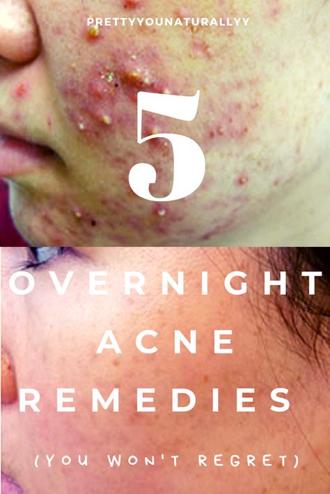 Clear Acne Overnight, Inflamed Pimple, Chin Acne, Back Acne Remedies, Acne Hacks, Overnight Acne Remedies, Acne Clearing, Forehead Acne, Bad Acne