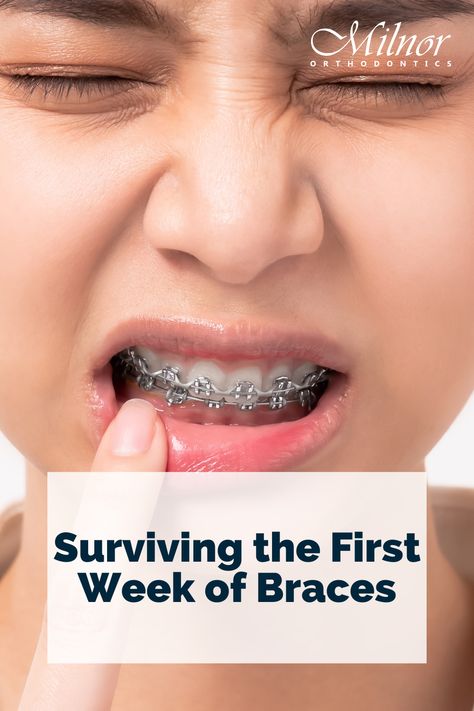 Surviving the First Week of Braces Braces With No Color, Braces Care Kit, Life With Braces, How To Prepare For Getting Braces, Things To Eat After Getting Braces, Things To Eat When You Have Braces, What To Eat After Braces, Braces Kit Survival, Soft Food Braces Ideas