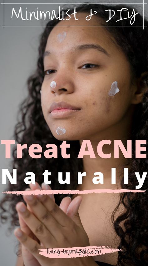Treat hormonal acne naturally following a simple, but effective DIY routine. Simple diet guidelines, the most effective supplement you should absolutely be taking, and a handful of natural but highly effective DIY ingredients. This routine cleared my acne in 3 months! | Treat acne naturally | Minimalist skincare | Acne skincare routine | DIY Skincare | Anti-acne diet | #acne #acnetips #clearacne #hormoneacne Acne Prone Skin Care Routine, Clear Up Acne, Treat Acne Naturally, Teenage Acne, Skincare Supplements, Minimalist Skincare, Face Mapping Acne, Acne Prone Skin Care, Forehead Acne