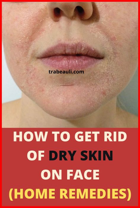 Natural Hacks For Your Skin Problems Face Dry Skin Remedies, Dry Face Remedy, Flaky Skin On Face, Dry Peeling Skin, Dry Skin Face Mask, Get Rid Of Dry Skin, Good Moisturizer, Facial For Dry Skin, Super Dry Skin