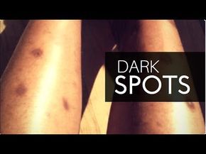 HOW TO GET RID OF DARK SPOTS ON LEGS & BODY FAST | GET CLEAR EVEN SKIN TONE ALL OVER! - YouTube Black Spots On Legs Remove, Hyperpigmentation Black Skin How To Get Rid Dark Spots, Dark Spots And Hyperpigmentation, Hyperpigmentation On Legs Dark Spots, How To Get Rid Of Scabs On Legs Fast, Black Elbows Get Rid Of, Black Spots On Face Remove Fast, How To Get Rid Of Dark Spots On Legs Diy, How To Get Rid Of Scars On Legs Diy