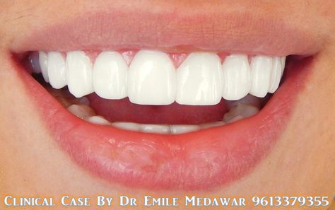 Hollywood Smile Veneers, Dental implant in Lebanon, Style Dental Clinic, Dentist in Beirut Lebanon, 00961 3 379355 Teeth Aesthetic, Pretty Teeth, Corps Idéal, Veneers Teeth, Beautiful Teeth, Porcelain Veneers, Perfect Teeth, Nice Teeth, Life Vision Board