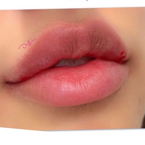 Plump Lips Subliminal, Ideal Face Inspiration, Perfect Lips Injections, Lips Subliminal, Lips Surgery, Lip Filler Shape Ideas, Lips Goals, Lip Filler Inspo, Lip Filler Before And After