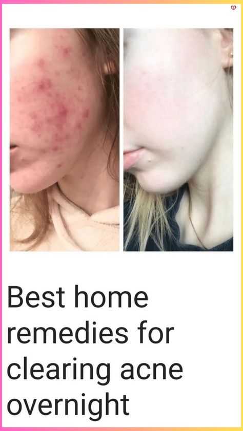 Goodbye Acne: Unleash Clear Skin with These Unexpected Natural Remedies Acne Removal Home Remedies, Heal Acne Naturally, Acne Natural Remedies, Home Remedy For Acne, Body Acne Remedies, Clear Acne Overnight, Overnight Remedies, Acne Home Remedies, Natural Remedies For Acne