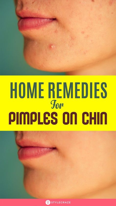 Home Remedies For Pimples On The Chin #acne #pimples #pimplesremedies #acneremedies #skincarediy. https://whispers-in-the-wind.com/combatting-pimples-under-the-skin-expert-tips-and-product-recommendations/?364 Breakout Remedies, Chin Breakouts, Chin Acne Causes, Remedies For Pimples, Chin Acne, Pimples On Chin, Blind Pimple, Home Remedies For Pimples, Pimples Under The Skin