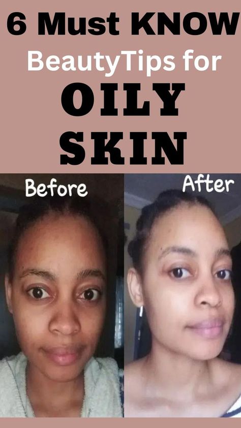 6 Must Know Beauty Tips for Oily Skin: Pollution and dirt can even lead to comedones (skin-bumps) for those with very oily skin. The solution for this is to keep the oil production in control by following some simple beauty and skin care tips for oily skin. These are the 6 tips for facial for oily skin. #Beauty #BeautyTips #OilySkin #SkinCaretips. Oily Skincare, Facial For Oily Skin, Skincare Supplements, Tips For Oily Skin, Skin Bumps, Oily Skin Care, Skin Care Solutions, Simple Beauty, Oily Skin