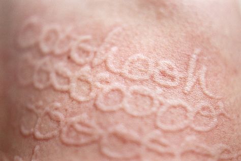 If You Have This Condition, You Can Write on Your Skin—No Pen Required Health Care, Skin Condition, Skin Disorders, Skin Art, Skin Conditions, Sweet Almond Oil, Make Art, Print Tattoos, Sensitive Skin