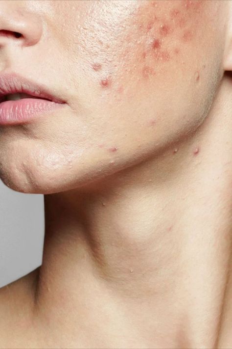 acne Mens Acne, Acne Aesthetic, Acne Photos, Skin Breakouts, Stubborn Acne, Remove Skin Tags Naturally, Face Mapping Acne, Forehead Acne, Acne Face