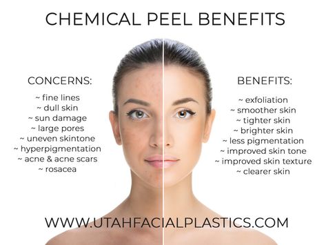 Chemical Peel Marketing, Benefits Of Dermaplaning, Chemical Peel Aesthetic, Chemical Peel Benefits, Hydrafacial Benefits, Esthetics Marketing, Peel Season, Environ Skincare, Chemical Face Peel