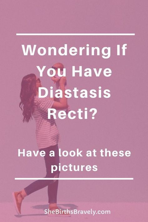 It is possible to heal your Diastasis Recti and lose your Mommy tummy? Need some inspiration? Then have a look at these before and after pictures of women who restored their core by following an exercise program and consistently working out. Click for a visual guide to diastasis recti.  #shebirthsbravely #doula #postpartum #diastasisrecti #mommytummy #fourthtrimester Diastasis Recti Exercises Workouts Videos, Core Workout For Diastasis Recti, Exercise Diastasis Recti, Mommy Tummy Before And After, Core Exercises For Diastasis Recti, Mommy Pooch Workout Diastasis Recti, Heal Diastasis Recti Fast, Healing Diastasis Recti Years Later, Lower Diastasis Recti Exercises