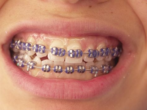 purple braces!! Purple Braces Aesthetic, Braces Lavender, Violet Braces, Lavender Braces, Purple Braces, Braces Aesthetic, Braces Colours, Invisible Teeth Braces, Braces Ideas