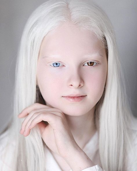 White Hair, Albino Person, Albino Human, Albino Model, Albino Girl, Eye Color, Her Hair, Chihuahua, Pretty People