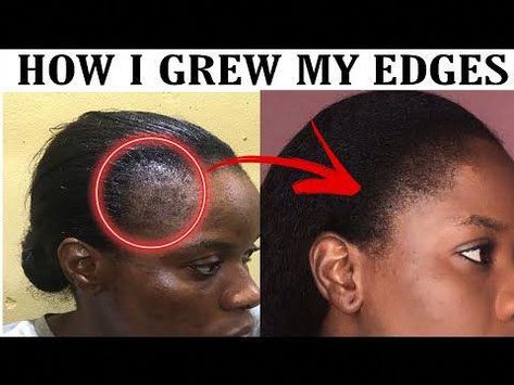 Having a bald spot or losing hair edges can be frustratingToday i share with you all the hair growth recipe of how i grew back my edges/hairline back natural... Coupe, Front Hair Growth Remedies, How To Grow Hair Edges Back Fast, How To Improve Hairline, Remedies For Hairline Growth, How To Grow Hairline Back, Growing Back Edges, How To Grow Front Hair, Edges Growth For Natural Hair