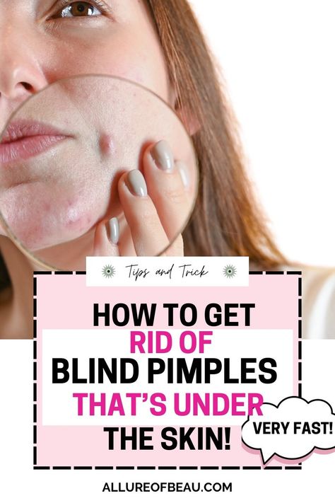 The Only Guide You Ever Need To Rid Of Blind Pimples & The Scar Left Behind! #acne #pimples #pimplesremedies #acneremedies #skincarediy. https://whispers-in-the-wind.com/combatting-pimples-under-the-skin-expert-tips-and-product-recommendations/?382 Overnight Pimple Remedies, Hard Pimple, Cover Up Pimples, How To Treat Pimples, Deep Pimple, Remedies For Pimples, Zit Remedy, Get Rid Of Pimples Overnight, Rid Of Pimples Overnight