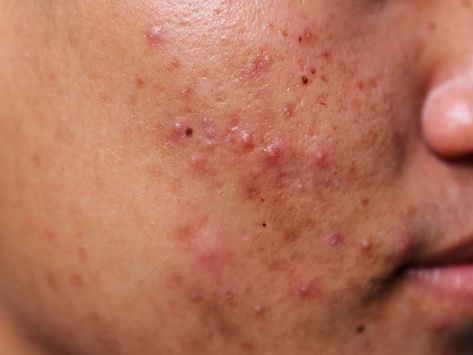 These powerful close-up photos of acne will change the way you think about your skin Acne Photos, Back Acne Remedies, Blind Pimple, Prevent Pimples, Pimples Under The Skin, Forehead Acne, Face Pores, How To Remove Pimples, Natural Acne Remedies