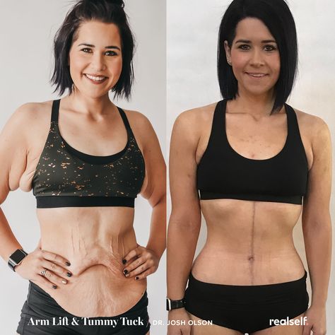 Significant weight loss often results in sagging skin due to lack of elasticity. For this result, a fleur de lis tummy tuck removed excess skin using a vertical incision, while an arm lift removed sagging skin on the arms. Tighten Loose Arm Skin, Tighten Skin On Stomach, Loose Stomach Skin, Loose Skin Removal Before And After, Stomach Skin Tightening, Loose Tummy Skin, Abdominalplasty Recovery, Mom Stomach Before And After, Tummy Tucks 360