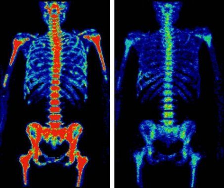 Pet Scan Image, Nurse Vibes, Human Skeletal System, Pet Ct, Medical Oncology, Pet Scan, Glass Of Red Wine, Nuclear Medicine, High Calcium