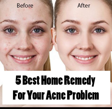 5 Best Home Remedy for Acne Problem | Fashion Everyday Best Home Remedy For Acne, Home Remedy For Acne, Remedy For Acne, Overnight Remedies, Essential Oils For Pregnancy, Fashion Everyday, Acne Problem, Home Remedies For Acne, Acne Solutions