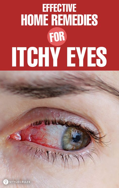 Eye Relief Remedies, Eye Inflammation Remedies, Eye Redness Remedies, Eye Wash Solution Home Remedies, Eyes Care Tips, Itchy Watery Eyes Remedies, Crusty Eyes Remedies, Burning Eyes Relief Remedies, Itchy Eyes Remedy Natural