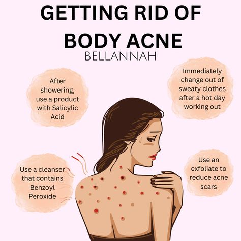 Acne On Back How To Get Rid, How To Rid Of Acne, How To Get Rid Of Acne On Back, Getting Rid Of Back Acne, How Get Rid Of Acne, How To Get Rid Of Body Acne Fast, Get Rid Of Back Acne Fast, Different Types Of Acne How To Get Rid, Tips For Back Acne