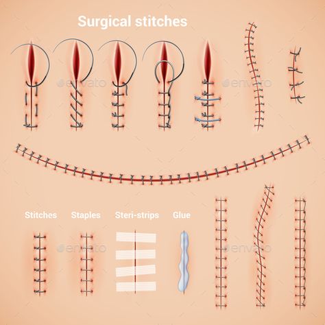 Surgical Stitches Infographic Set #Stitches, #Surgical, #Set, #Infographic Surgical Stitches, Studera Motivation, Surgical Suture, Surgical Technologist, Vet Medicine, Medicine Studies, Surgical Nursing, Medical Student Study, Nursing School Survival