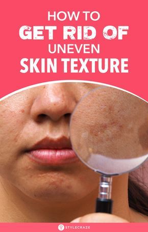 How To Get Rid Of Uneven Skin Texture On Face: If you have paid attention to the skin on your face, you would have noticed that sometimes, the texture of the skin on some areas of the face is very different from the rest of it. Want to know why this happens? We have put together a list of home remedies which will help you in treating this skin issue in a far gentler way by making use of ingredients available at home. #Skin #SkinCare #SkinCareTips Spots On Forehead, Brown Spots On Hands, Brown Age Spots, Textured Skin, Brown Spots On Skin, Uneven Skin Texture, Brown Spots Removal, Brown Spots On Face, Skin Spots