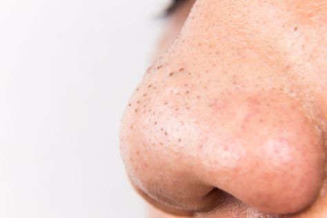 Blackheads and Clogged Pores Are Not the Same Thing Blackheads On Cheeks, What Are Blackheads, Blackhead Remedies, Black Head Remover Mask, Blackheads On Nose, Natural Acne Remedies, How To Remove Pimples, How To Get Rid Of Pimples, Get Rid Of Blackheads