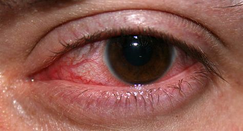 What to do if you have an inflamed eye...bc I have one right now :( Dry Skin Under Eyes, Dry Cracked Lips, Bloodshot Eyes, Eye Twitching, Swollen Eyes, Vampire Makeup, Eye Infections, Cracked Lips, Lotion For Dry Skin