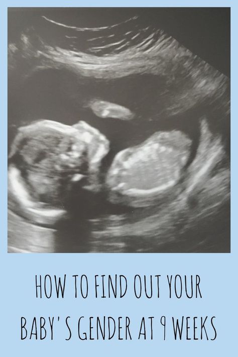 How to find out your baby’s gender at 9 weeks Baby Heartbeat Gender Prediction, Heartbeat Gender Prediction, Gender Prediction Ultrasound, Baby Heart Rate Gender, Ultrasound Boy Or Girl, 9 Weeks Pregnant Ultrasound, Boy Vs Girl Pregnancy, Baby Gender Ultrasound, Baby At 10 Weeks