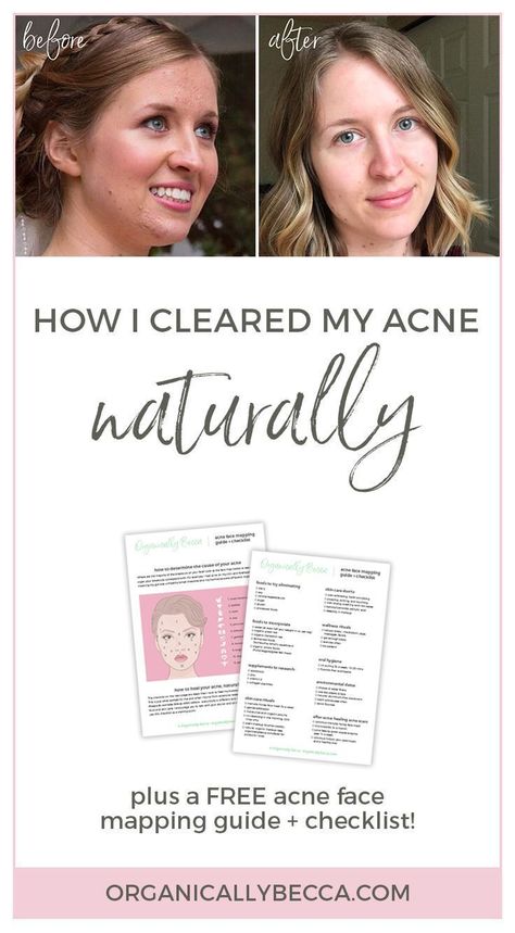 Acne face mapping guide, how to clear hormonal, cystic acne naturally #acnetipsremedies Hormonal acne diet plan to help you get rid of cystic acne and PCOS acne. What foods to eat for beauty and acne-free skin. #AcneScars