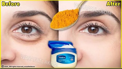 In 3 days, remove bags under the eyes, dark circles, wrinkles and puffy eyes. | In 3 days, remove bags under the eyes, dark circles, wrinkles and puffy eyes. | By Natural beauty secret Eye Wrinkles Remedies, Face Wrinkles Remedies, Puffy Eyes Remedy, Tighten Neck Skin, Wrinkles Remedies Face, Remove Eye Bags, Diy Wrinkles, Flot Makeup, Wrinkle Remedies